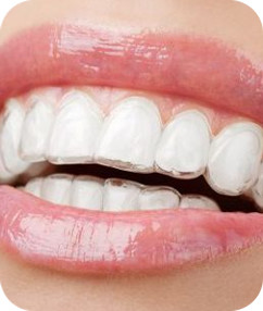 NIỀNG RĂNG TRONG SUỐT INVISALIGN